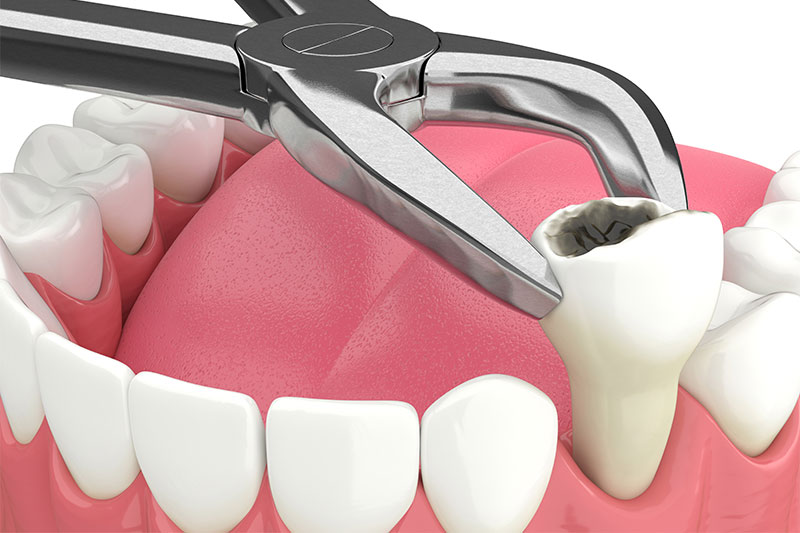 Tooth Extractions in San Antonio